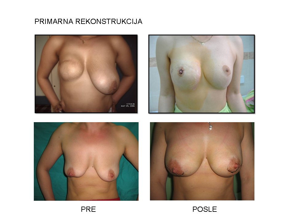 Primarna rekonstrukcija